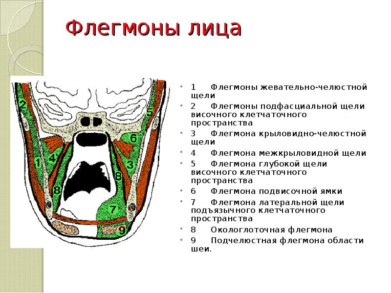 Флегмоны лица  1	Флегмоны жевательно-челюстной щели 2	Флегмоны подфасциальной щели височного клетчаточного