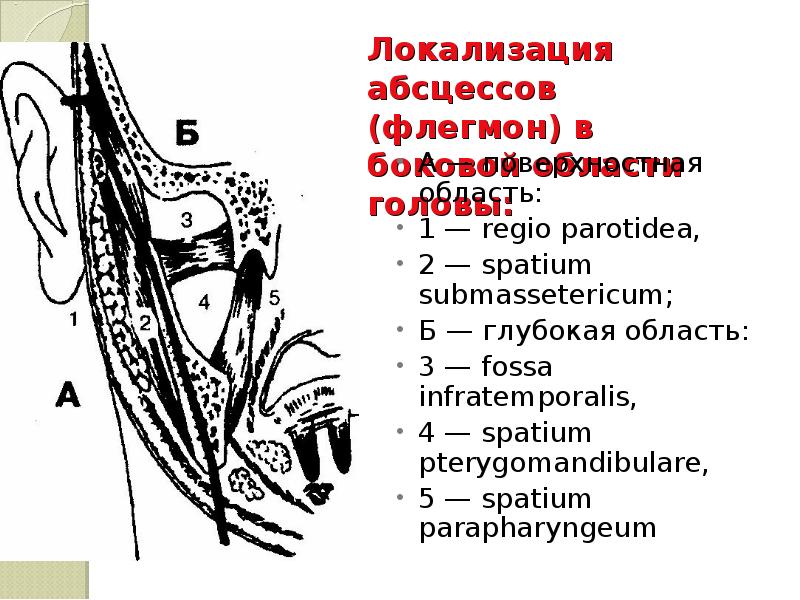 Локализация абсцессов (флегмон) в боковой области головы:  А — поверхностная