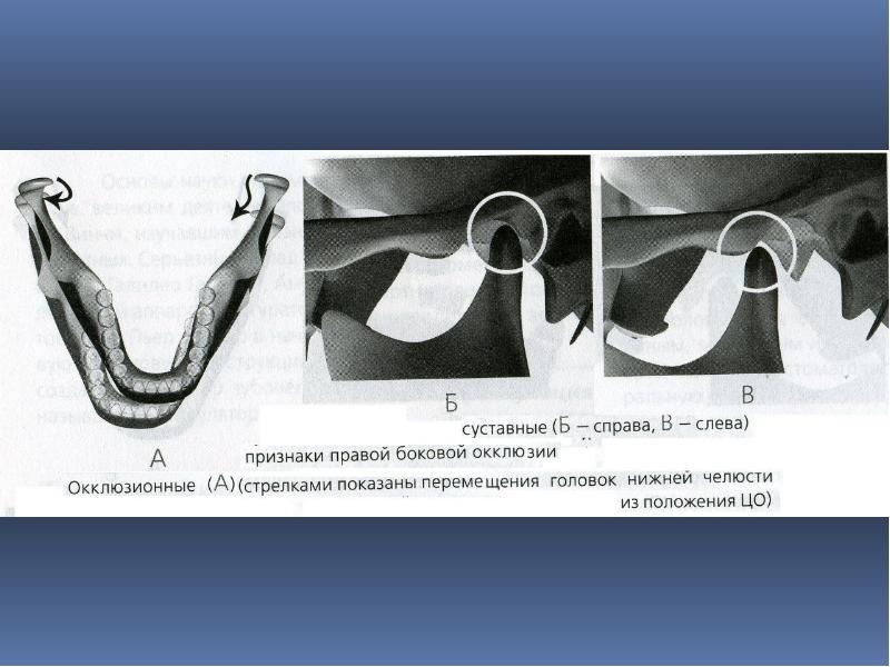 Окклюзия. Суставной признак боковой окклюзии. Признаки боковой окклюзии. Суставной признак центральной окклюзии. Суставные признаки центральной окклюзии.