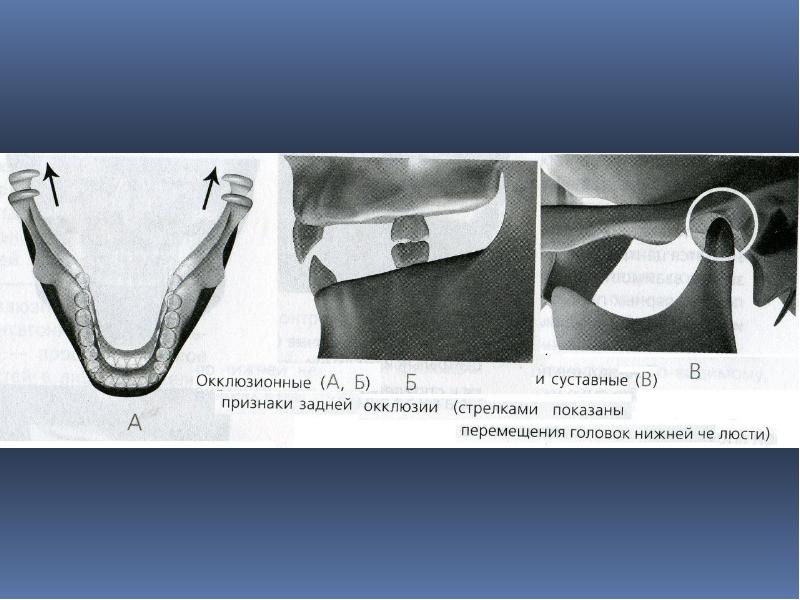 Окклюзия симптомы. Суставной признак окклюзии. Признаки боковой окклюзии.
