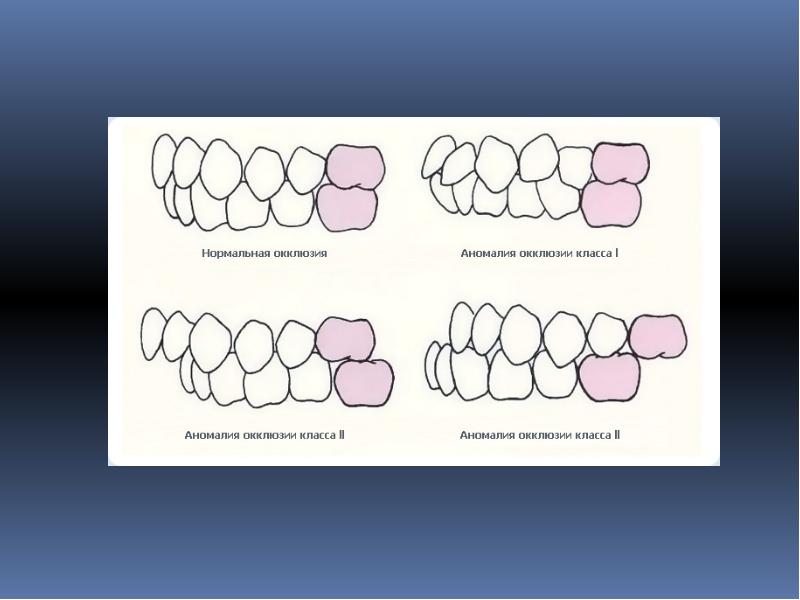 Классы окклюзии. Центральная окклюзия.