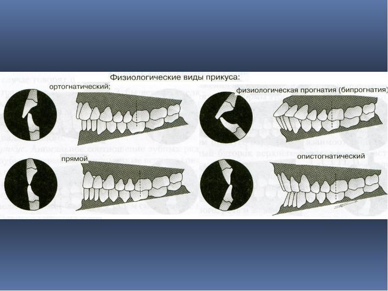 Виды прикуса. Опистогнатический прикус окклюзия. Виды физиологического прикуса. Физиологический прику. Физиологические виды прику.