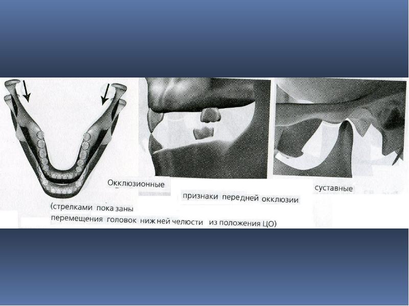 Признаки окклюзии