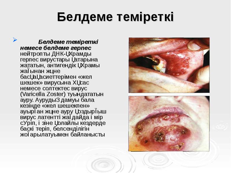 Белдеме теміреткі
Белдеме теміреткі немесе белдеме герпес нейтропты ДНК-құрамды Белдеме теміреткі
Белдеме теміреткі немесе белдеме герпес нейтропты ДНК-құрамды