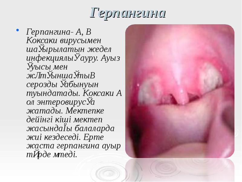 Герпангина
Герпангина- А, В Коксаки вирусымен шақырылатын жедел инфекциялық ауру. Ауыз Герпангина
Герпангина- А, В Коксаки вирусымен шақырылатын жедел инфекциялық ауру. Ауыз