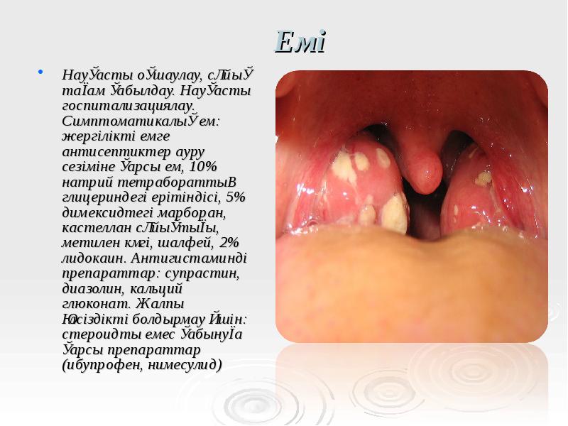 Емі
Науқасты оқшаулау, сұйық тағам қабылдау. Науқасты госпитализациялау. Симптоматикалық ем: жергілікті Емі
Науқасты оқшаулау, сұйық тағам қабылдау. Науқасты госпитализациялау. Симптоматикалық ем: жергілікті