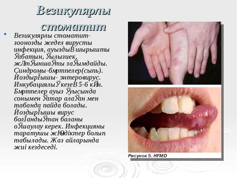 Везикулярлы стоматит
Везикулярлы стоматит- зоонозды жедел вирусты инфекция, ауыздың шырышты қабатын, Везикулярлы стоматит
Везикулярлы стоматит- зоонозды жедел вирусты инфекция, ауыздың шырышты қабатын,