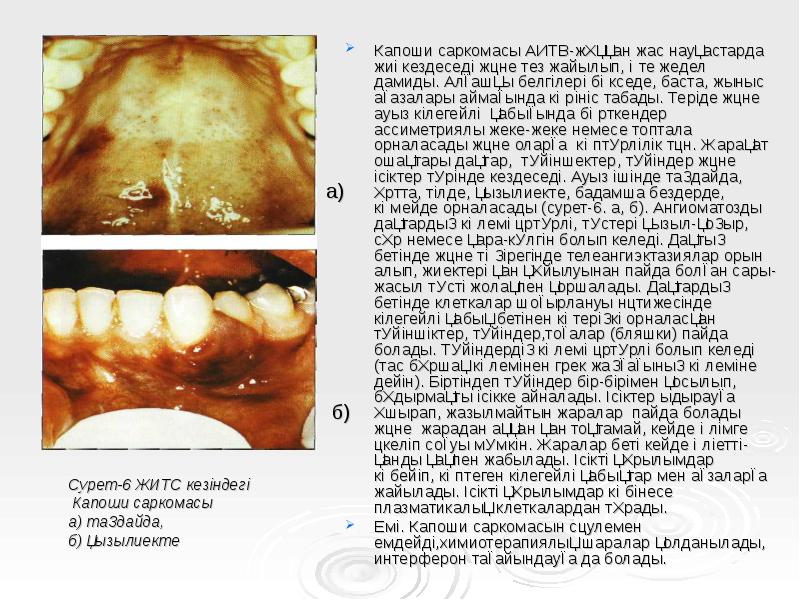 Капоши саркомасы АИТВ-жұққан жас науқастарда жиі кездеседі және тез жайылып, өте Капоши саркомасы АИТВ-жұққан жас науқастарда жиі кездеседі және тез жайылып, өте