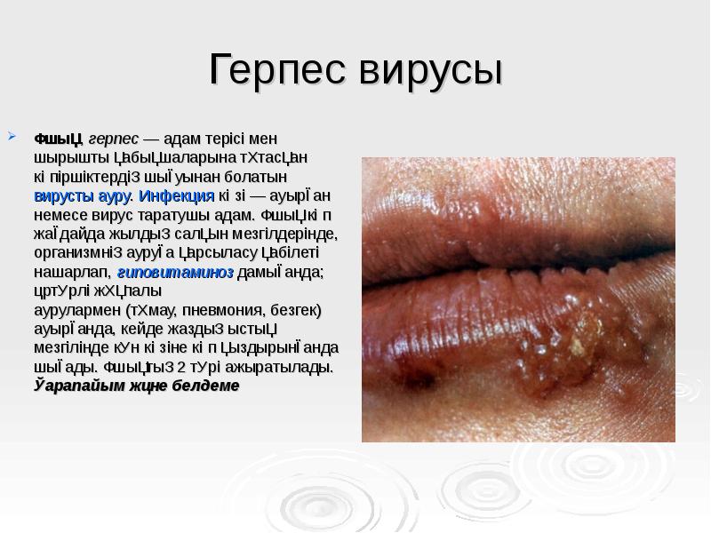 Герпес вирусы
Ұшық, герпес — адам терісі мен шырышты қабықшаларына тұтасқан көпіршіктердің шығуынан болатын вирусты ауру. Инфекция көзі — Герпес вирусы
Ұшық, герпес — адам терісі мен шырышты қабықшаларына тұтасқан көпіршіктердің шығуынан болатын вирусты ауру. Инфекция көзі —