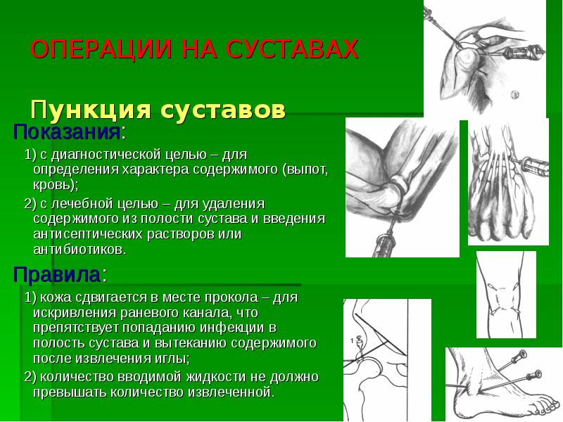 Реферат: Ампутации и экзартикуляции