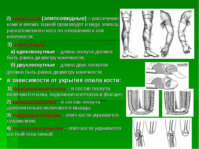 Реферат: Ампутации и экзартикуляции