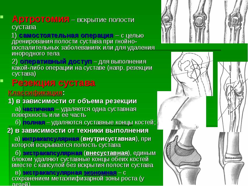 Реферат: Ампутации и экзартикуляции