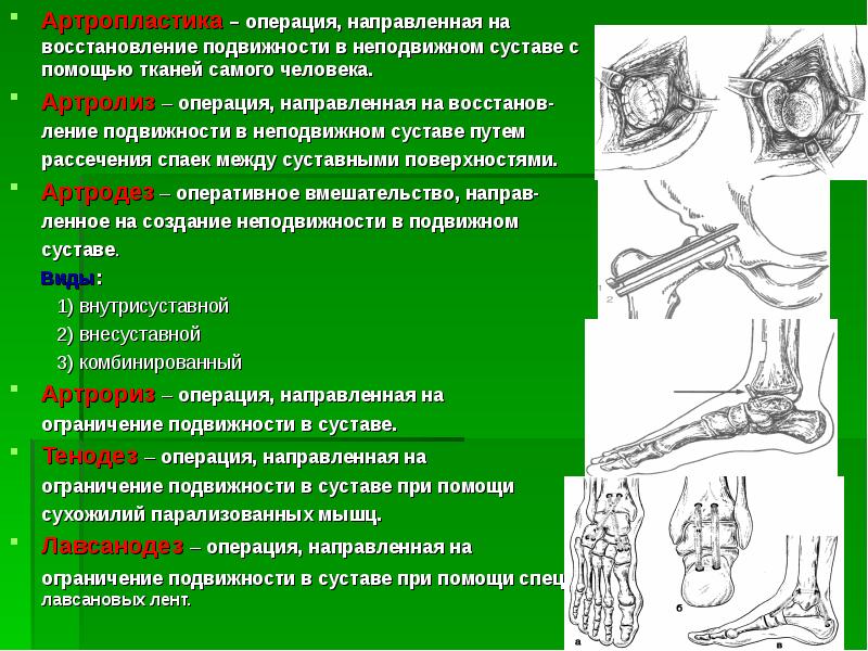 Реферат: Ампутации и экзартикуляции