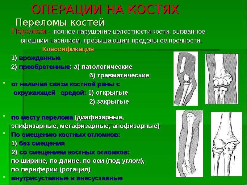 Здоровье перелом. Классификация операций на костях и суставах. Классификация переломов хирургия. Классификация лечения переломов костей конечности. Перелом длинных трубчатых костей клиника.