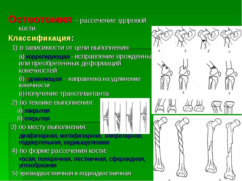 Реферат: Ампутации и экзартикуляции