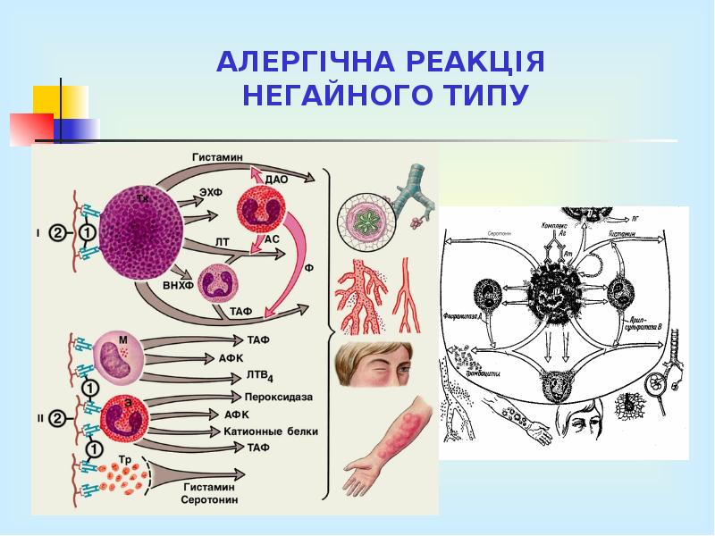 АЛЕРГІЧНА РЕАКЦІЯ НЕГАЙНОГО ТИПУ АЛЕРГІЧНА РЕАКЦІЯ НЕГАЙНОГО ТИПУ