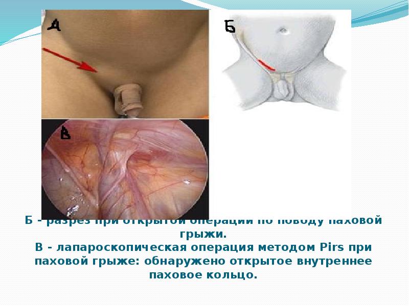 Грыжи у детей презентация