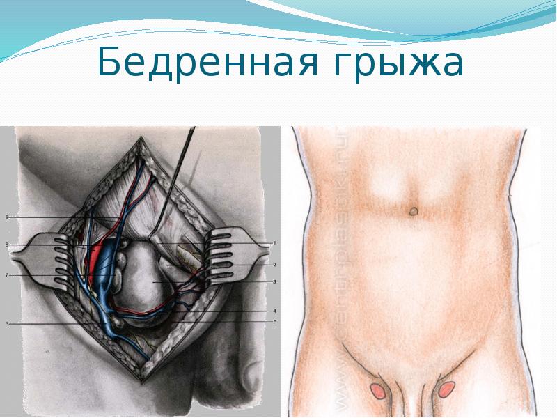 Грыжи у детей презентация