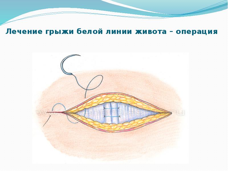 Лечение грыжи белой линии живота – операция