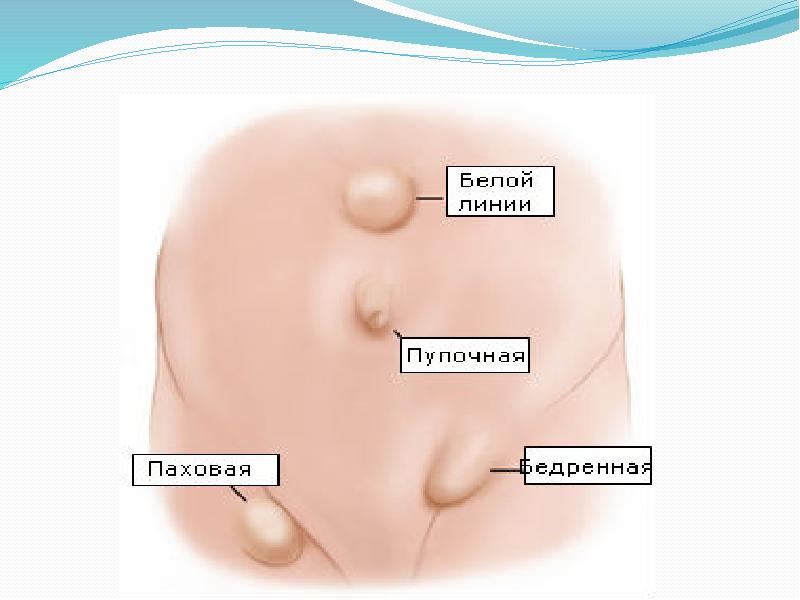 Грыжи у детей презентация