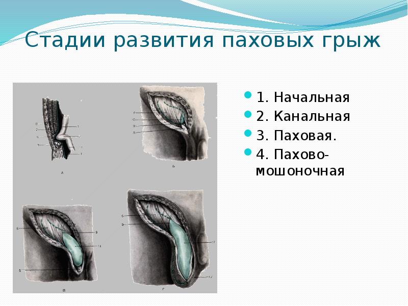 Грыжи у детей презентация