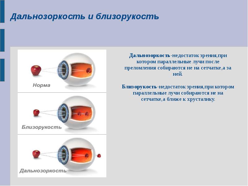 Презентация близорукость и дальнозоркость