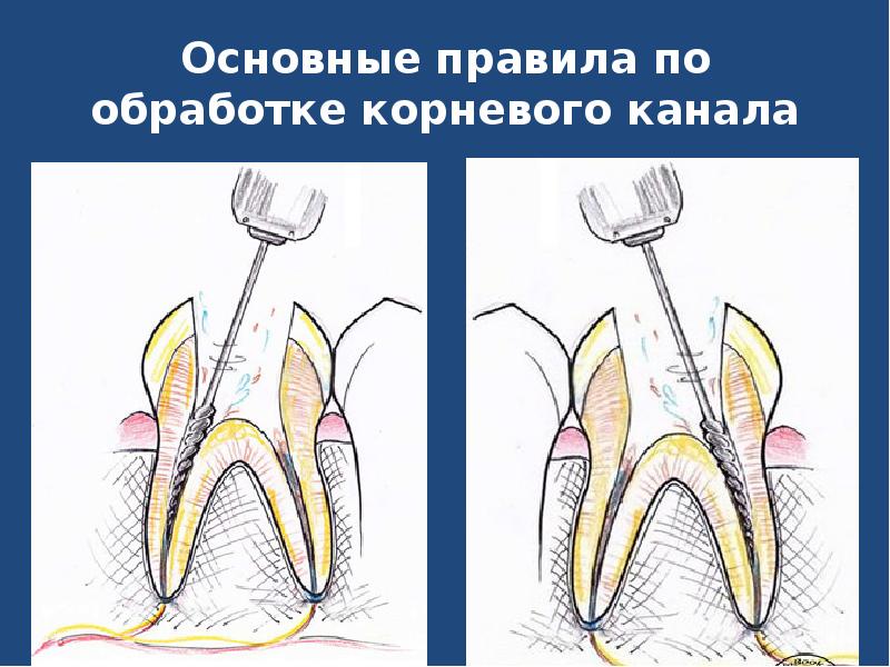 Эндолечение зубов в стоматологии схема