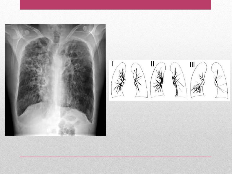 Бронхоэктатическая болезнь рисунки