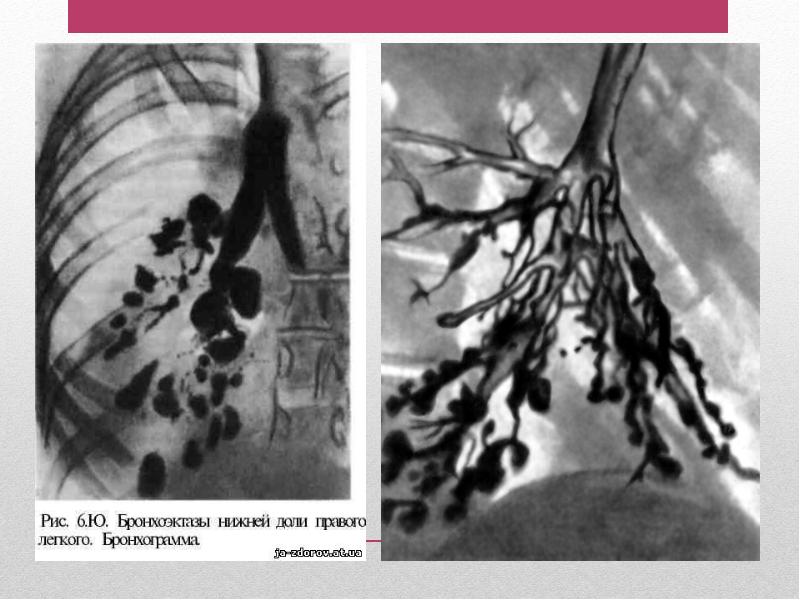 Бронхоэктатическая болезнь рисунки