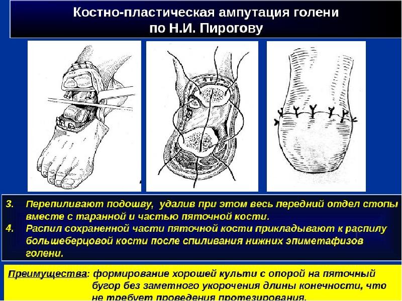 Оперативная хирургия нижней конечности презентация