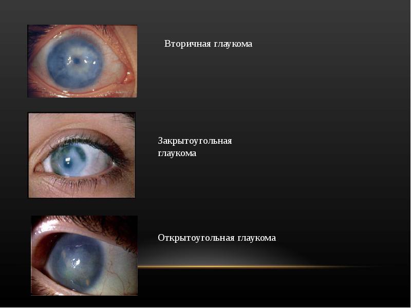 Глаукома презентация офтальмологии