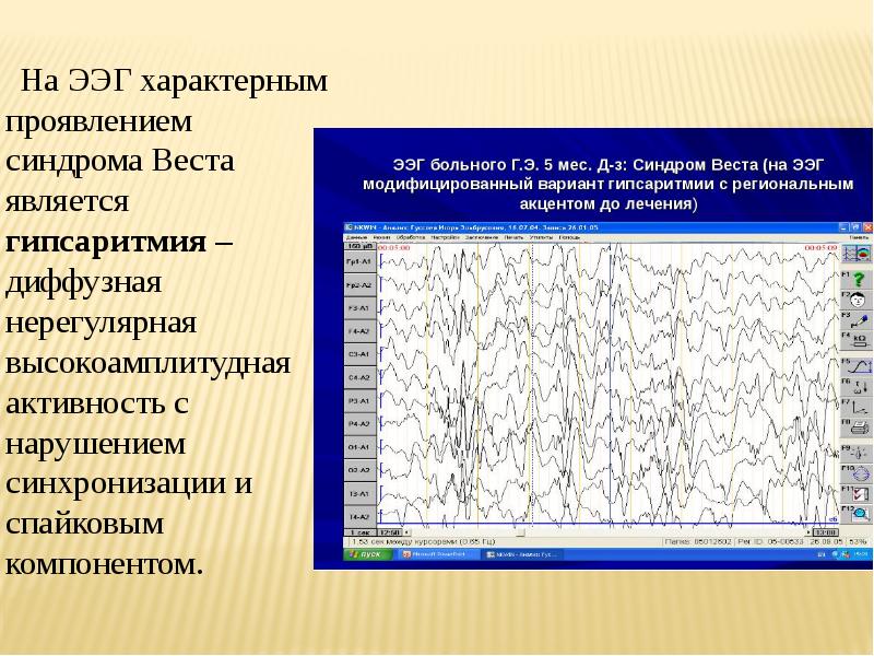 Синдром веста видео приступа