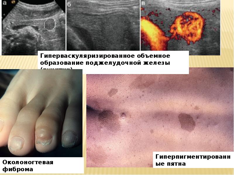 Туберозные ксантомы фото