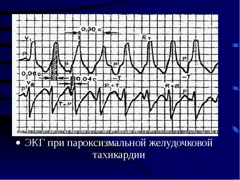 Желудочковые тахикардии презентация