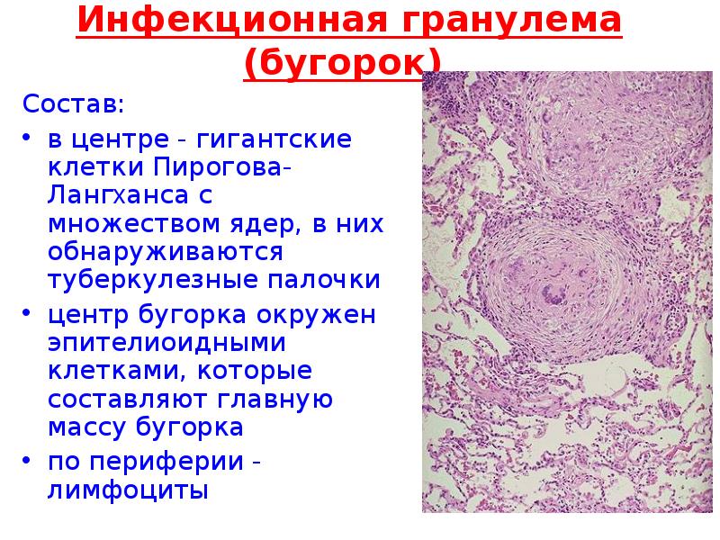 Гигантские клетки лангханса