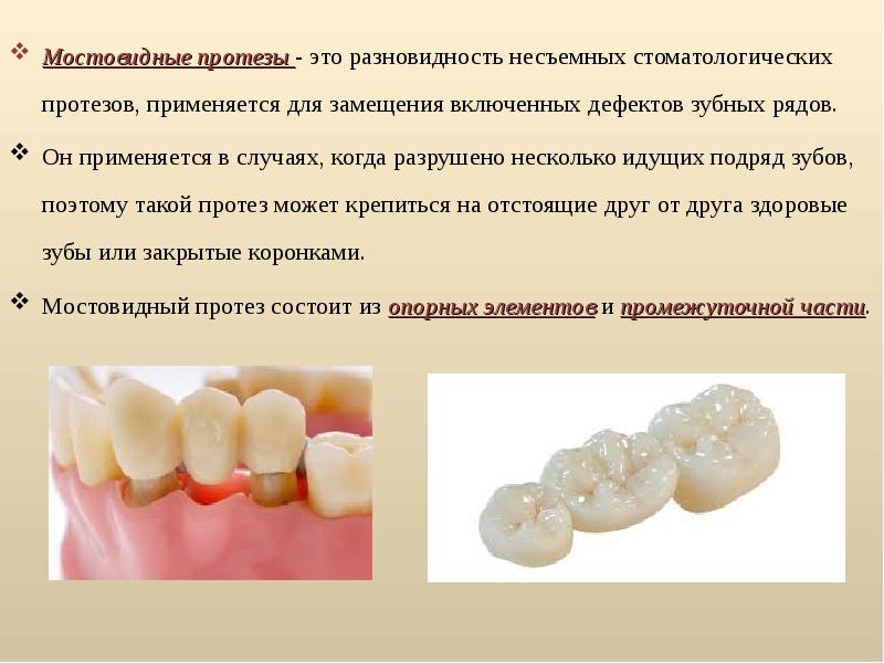 Мостовидные протезы: конструкция, виды, особенности