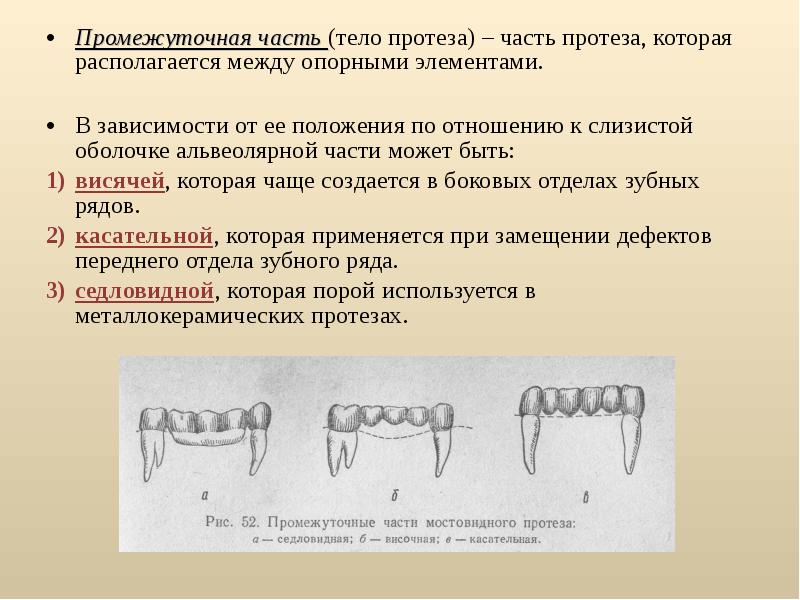 Мостовидный протез – что это такое: какие бывают виды …