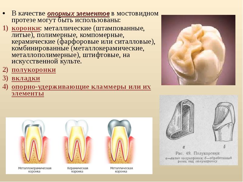 Мостовидные протезы - что это, виды, какие лучше, как …