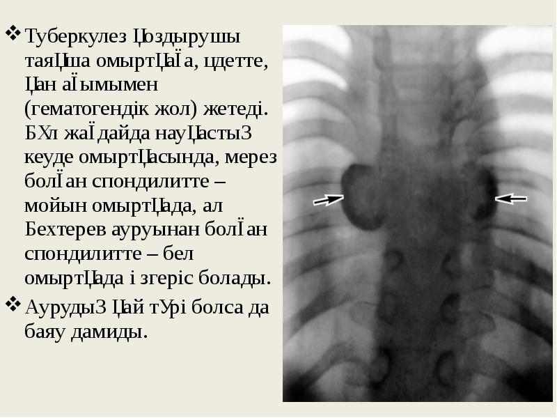 Мерез ауруы презентация