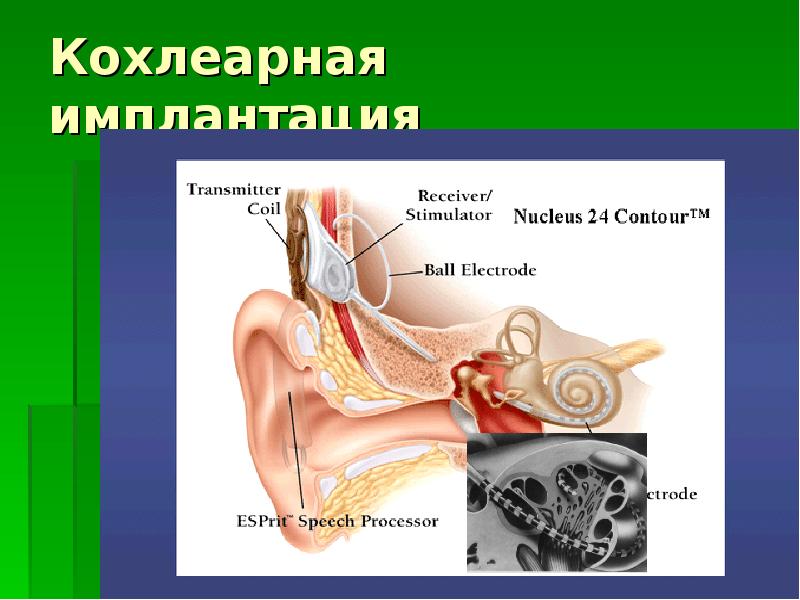 Кохлеарный отосклероз. Патологии уха презентация. пробы кохлеарной формой отосклероза?.
