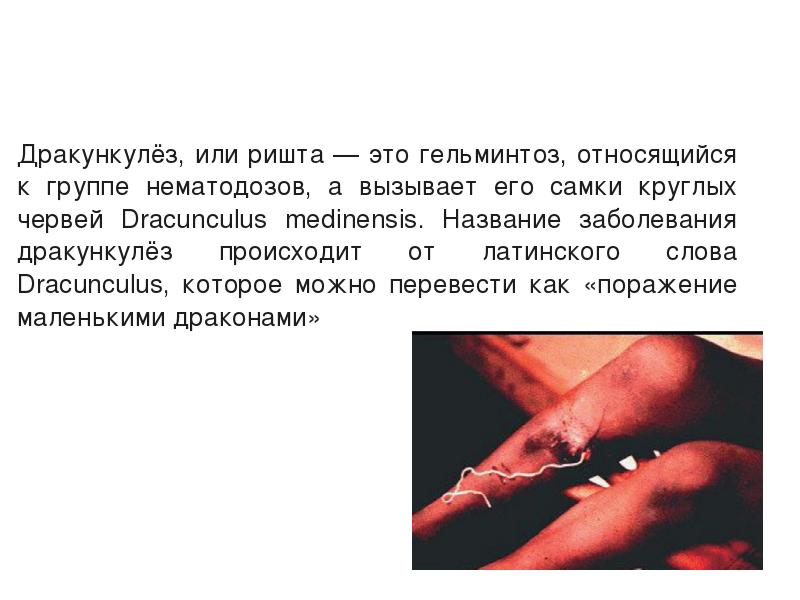 Дракункулёз, или ришта — это гельминтоз, относящийся к группе нематодозов, а Дракункулёз, или ришта — это гельминтоз, относящийся к группе нематодозов, а