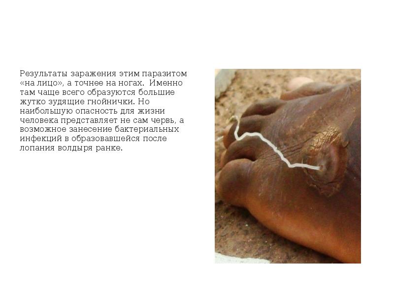 Результаты заражения этим паразитом «на лицо», а точнее на ногах. Именно Результаты заражения этим паразитом «на лицо», а точнее на ногах. Именно