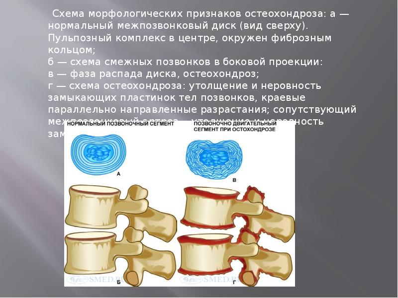 Остеохондроз межпозвонковых дисков. Остеохондроз презентация. Презентация на тему остеохондроз. Остеохондроз развивается в результате. Остеохондроз схема.