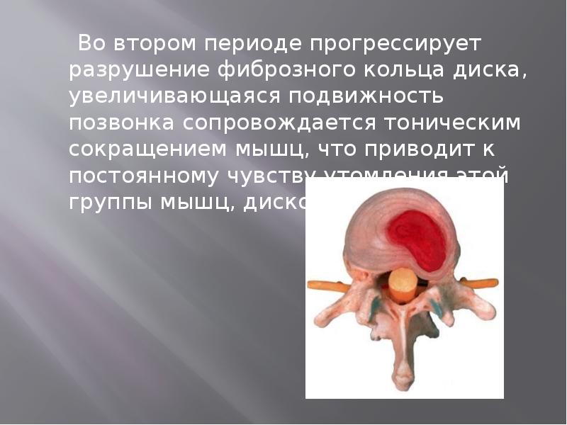 Во втором периоде прогрессирует разрушение фиброзного кольца диска, увеличивающаяся подвижность позвонка Во втором периоде прогрессирует разрушение фиброзного кольца диска, увеличивающаяся подвижность позвонка