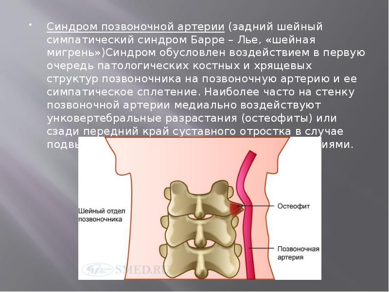 Синдром шейной артерии лечение. Симптомы поражения позвоночной артерии. Синдром позвоночной артерии. Синлромпозвоночной артерии. Задний шейный симпатический синдром (синдром позвоночной артерии)..