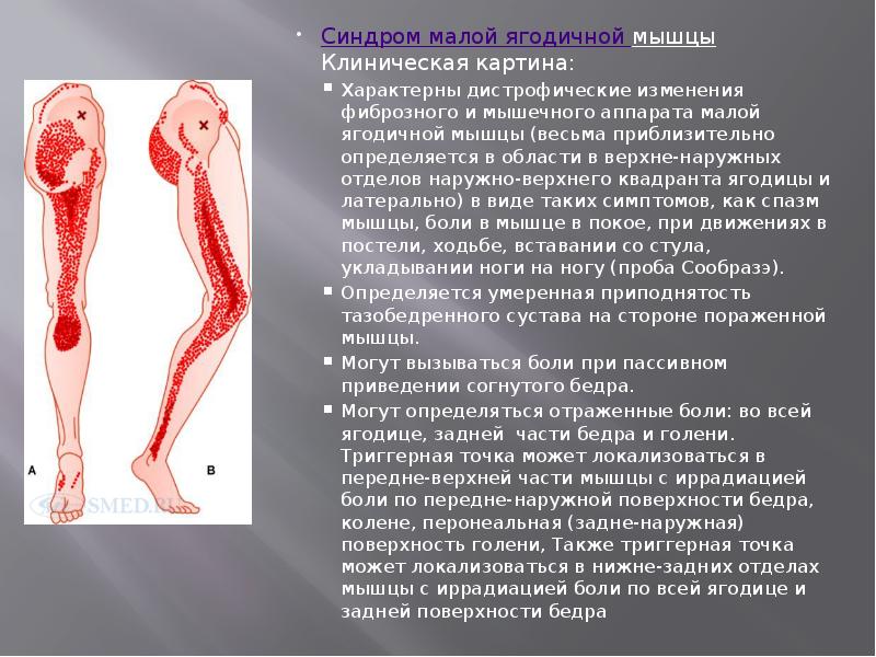 Синдром малой ягодичной мышцыКлиническая картина:
Синдром малой ягодичной мышцыКлиническая картина:
Характерны Синдром малой ягодичной мышцыКлиническая картина:
Синдром малой ягодичной мышцыКлиническая картина:
Характерны