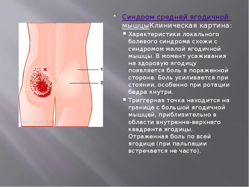 Синдром средней ягодичной мышцыКлиническая картина:
Синдром средней ягодичной мышцыКлиническая картина:
Характеристики Синдром средней ягодичной мышцыКлиническая картина:
Синдром средней ягодичной мышцыКлиническая картина:
Характеристики