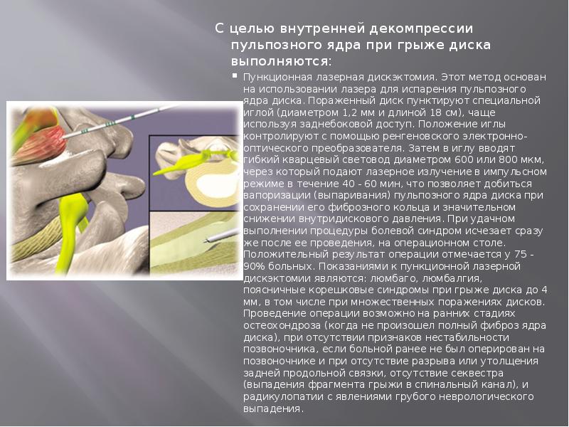 C целью внутренней декомпрессии пульпозного ядра при грыже диска выполняются:
C C целью внутренней декомпрессии пульпозного ядра при грыже диска выполняются:
C