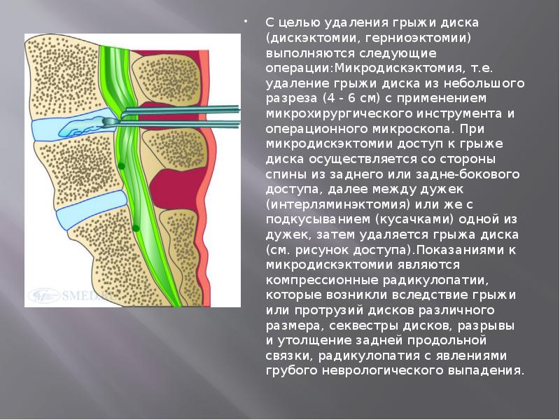 С целью удаления грыжи диска (дискэктомии, герниоэктомии) выполняются следующие операции:Микродискэктомия, т.е. С целью удаления грыжи диска (дискэктомии, герниоэктомии) выполняются следующие операции:Микродискэктомия, т.е.