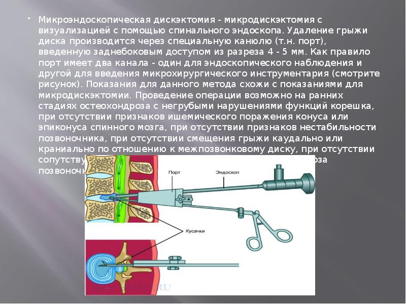 Микроэндоскопическая дискэктомия - микродискэктомия с визуализацией с помощью спинального эндоскопа. Удаление Микроэндоскопическая дискэктомия - микродискэктомия с визуализацией с помощью спинального эндоскопа. Удаление